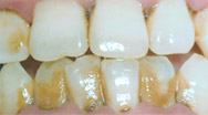 牙博士口腔牙周综合治疗案例一:治疗前