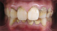 牙博士口腔牙周综合治疗案例二:治疗前