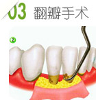 牙周病手术治疗第三步：翻瓣手术