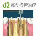 牙周病非手术治疗第二步：微创根管治疗