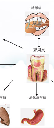 牙周病危害图解二：吸烟是导致牙周病发的一大害！