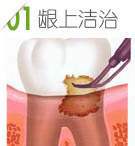 牙周病手术治疗第一步：龈上洁治