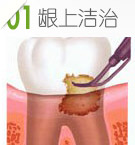 牙周病非手术治疗第一步：龈上洁治