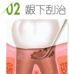 牙周病手术治疗第二步：龈下刮治